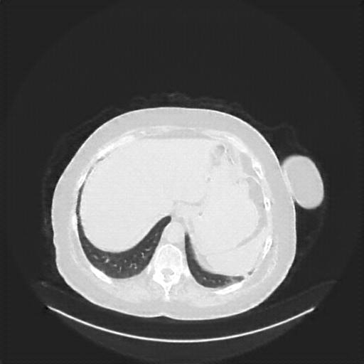 Reconstructed NATIVE CT scan (cycle consistency)