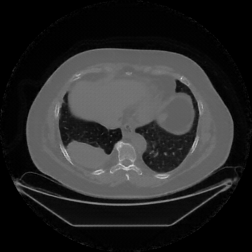 Reconstructed NATIVE CT scan (cycle consistency)