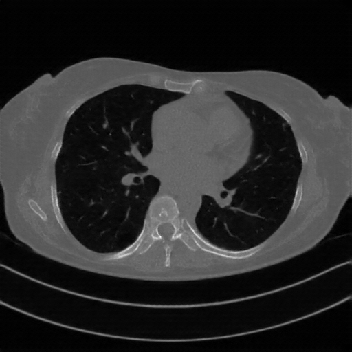 Reconstructed NATIVE CT scan (cycle consistency)