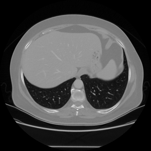 Original VENOUS CT scan