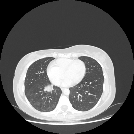 Original VENOUS CT scan