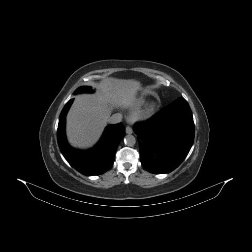 Original NATIVE CT scan (input)