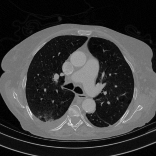 Original VENOUS CT scan