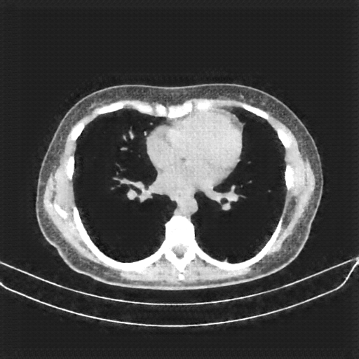 Generated VENOUS CT scan (A→B translation)