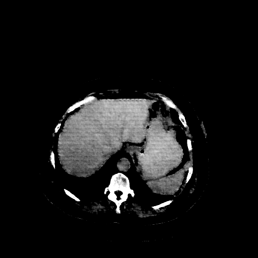 Generated VENOUS CT scan (A→B translation)