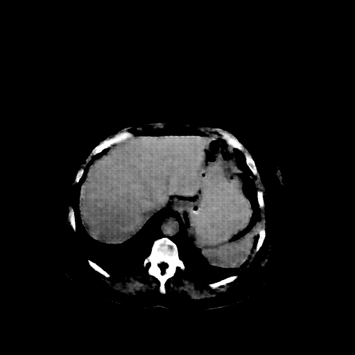 Reconstructed NATIVE CT scan (cycle consistency)