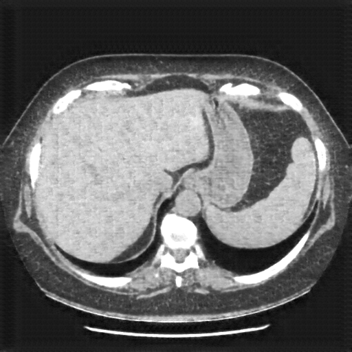 Generated VENOUS CT scan (A→B translation)