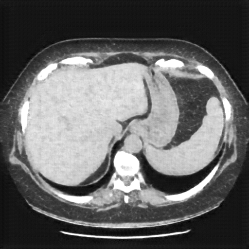 Reconstructed NATIVE CT scan (cycle consistency)