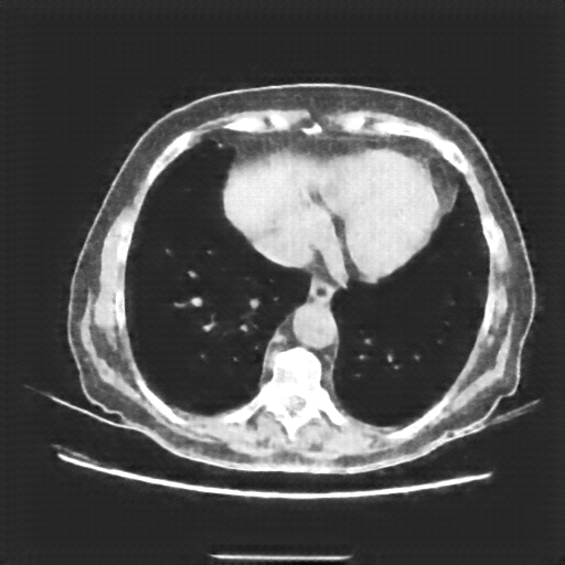 Reconstructed NATIVE CT scan (cycle consistency)