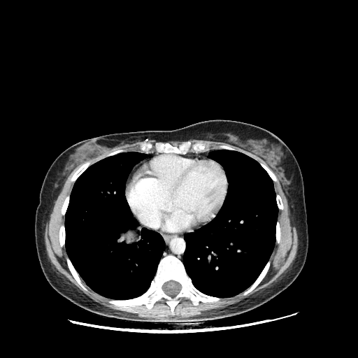 Original VENOUS CT scan