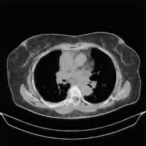 Reconstructed NATIVE CT scan (cycle consistency)