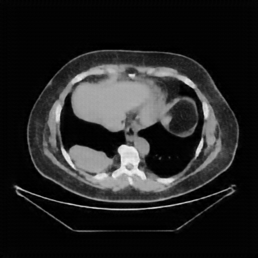 Reconstructed NATIVE CT scan (cycle consistency)