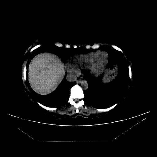 Reconstructed NATIVE CT scan (cycle consistency)