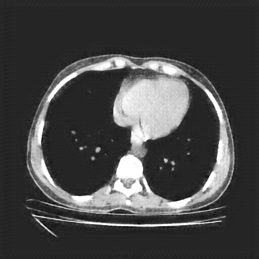 Generated VENOUS CT scan (A→B translation)