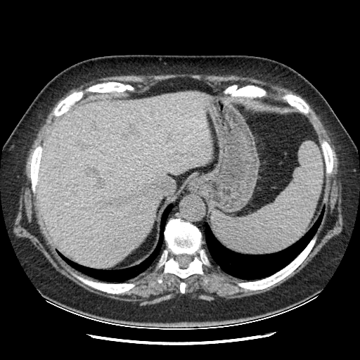 Original NATIVE CT scan (input)