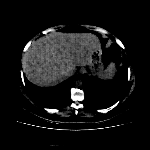 Reconstructed NATIVE CT scan (cycle consistency)