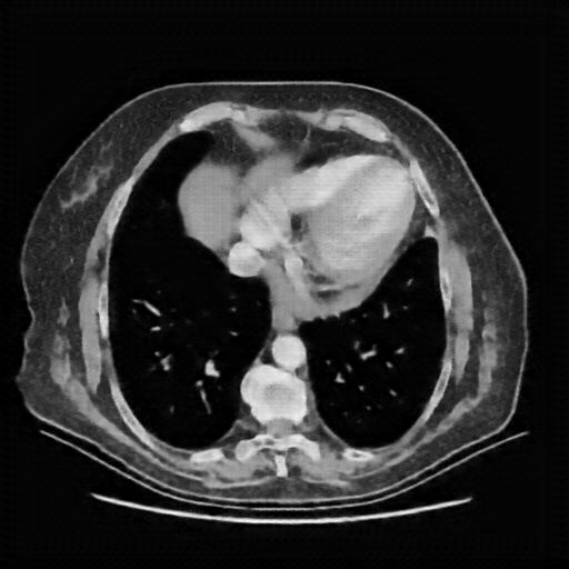 Reconstructed NATIVE CT scan (cycle consistency)