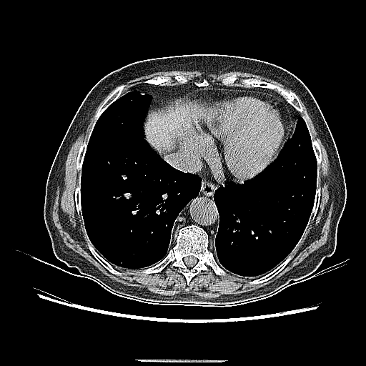 Original NATIVE CT scan (input)