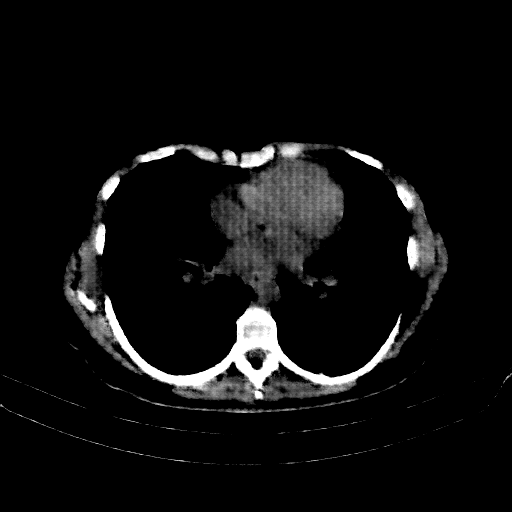 Reconstructed NATIVE CT scan (cycle consistency)