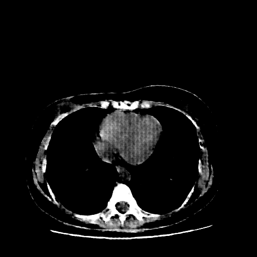 Reconstructed NATIVE CT scan (cycle consistency)