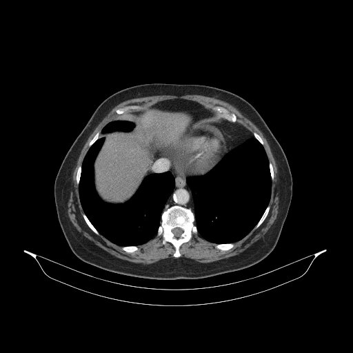 Original VENOUS CT scan