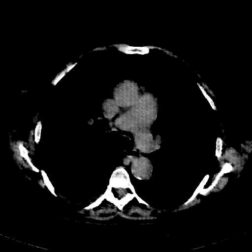 Reconstructed NATIVE CT scan (cycle consistency)
