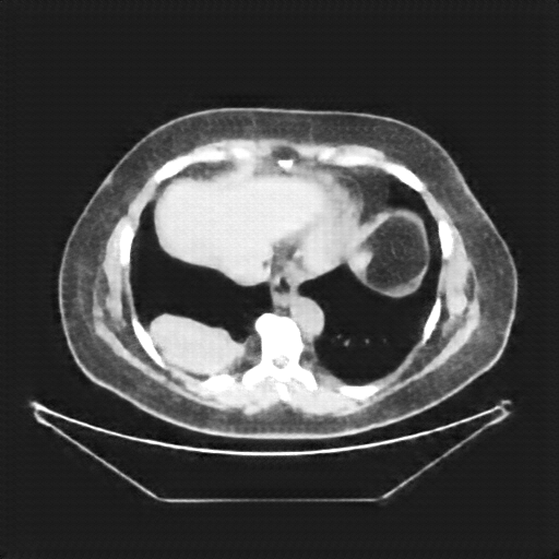 Reconstructed NATIVE CT scan (cycle consistency)