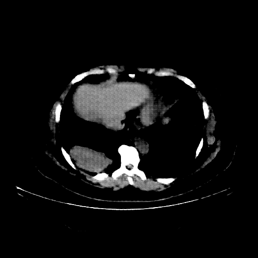 Reconstructed NATIVE CT scan (cycle consistency)