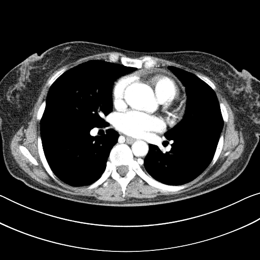 Original VENOUS CT scan