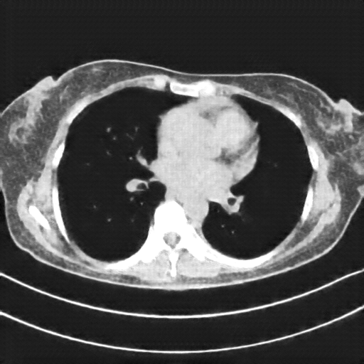 Reconstructed NATIVE CT scan (cycle consistency)