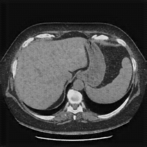 Generated VENOUS CT scan (A→B translation)