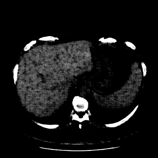 Reconstructed NATIVE CT scan (cycle consistency)