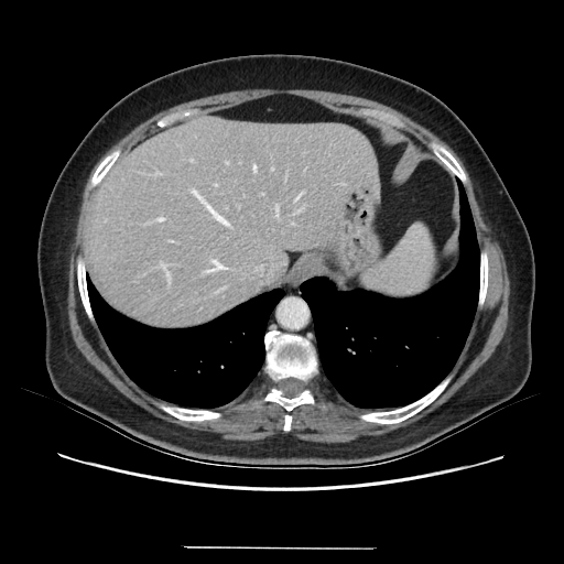 Original VENOUS CT scan