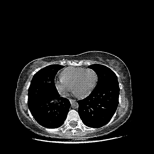 Reconstructed NATIVE CT scan (cycle consistency)