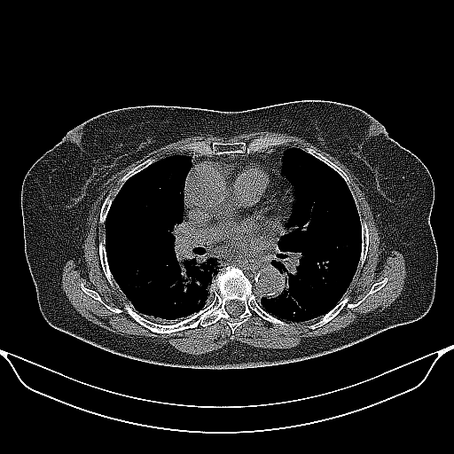 Original NATIVE CT scan (input)