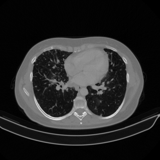 Original VENOUS CT scan