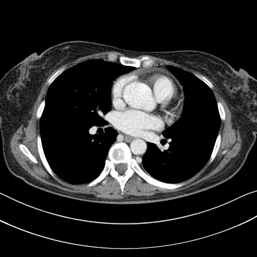 Original VENOUS CT scan