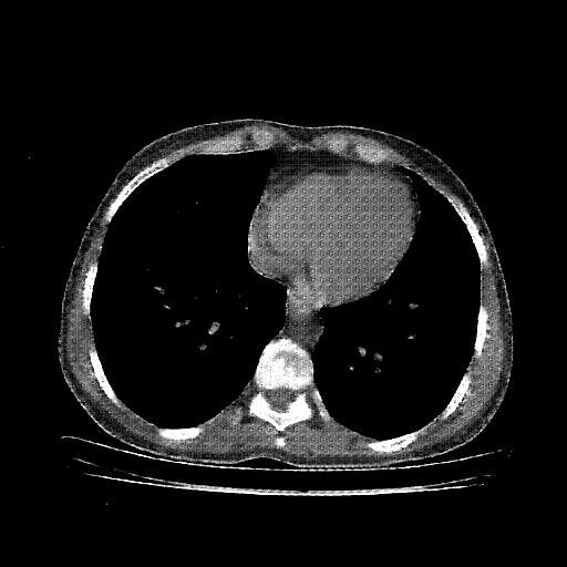 Reconstructed NATIVE CT scan (cycle consistency)