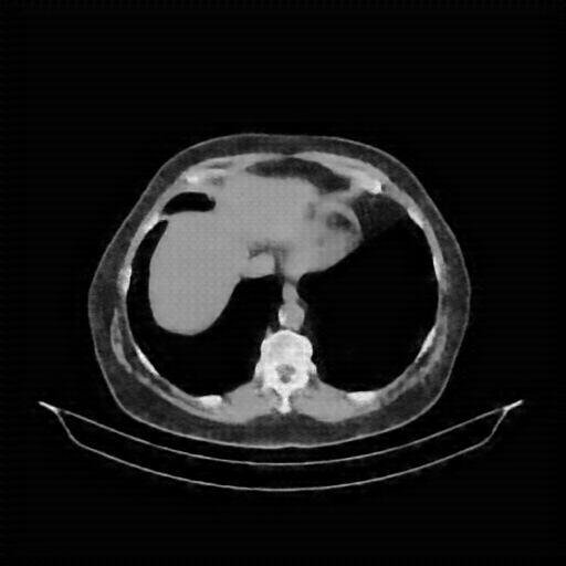 Reconstructed NATIVE CT scan (cycle consistency)