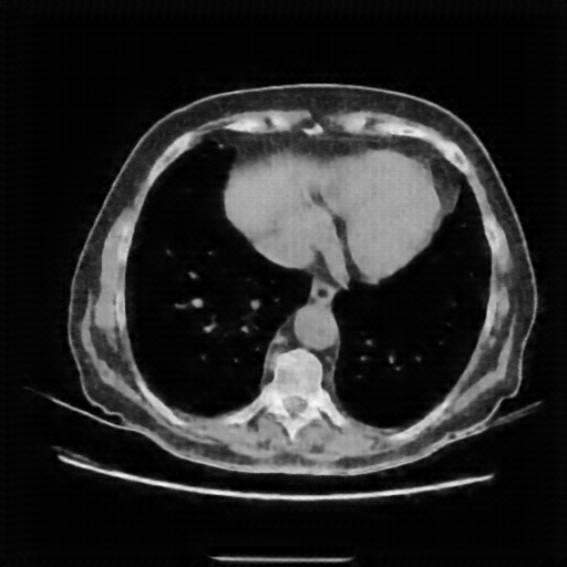Reconstructed NATIVE CT scan (cycle consistency)