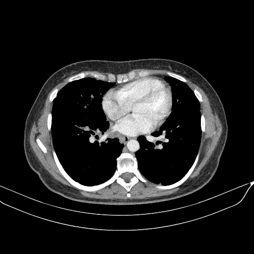 Original VENOUS CT scan