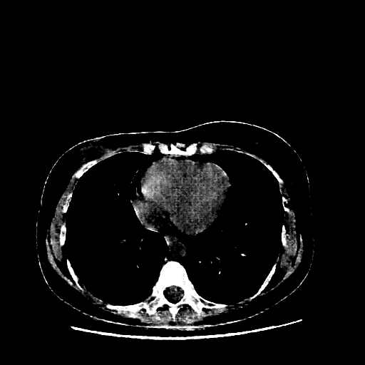 Generated VENOUS CT scan (A→B translation)