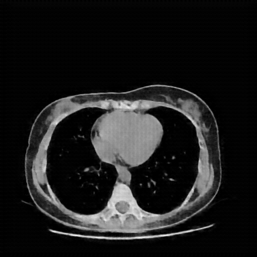 Reconstructed NATIVE CT scan (cycle consistency)