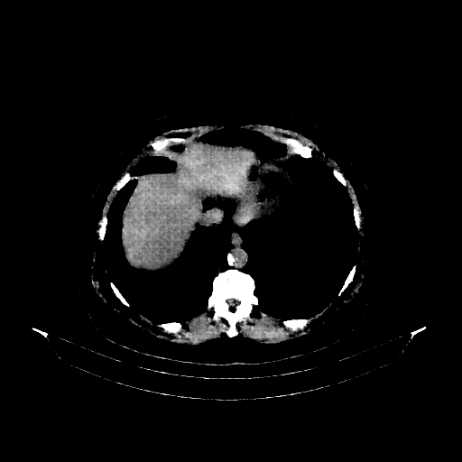Generated VENOUS CT scan (A→B translation)
