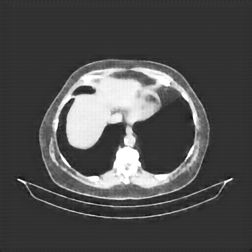 Reconstructed NATIVE CT scan (cycle consistency)
