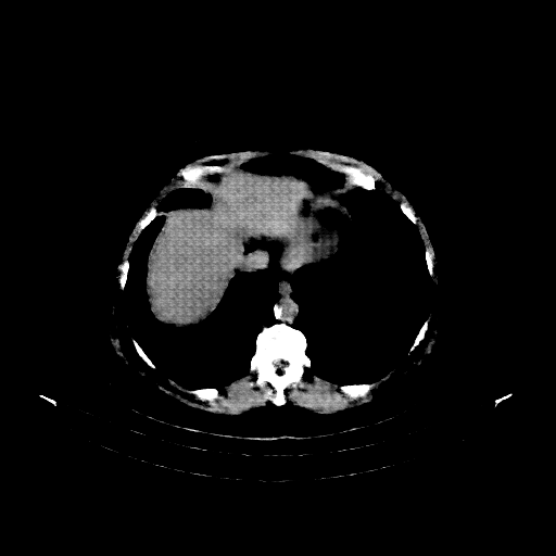 Reconstructed NATIVE CT scan (cycle consistency)