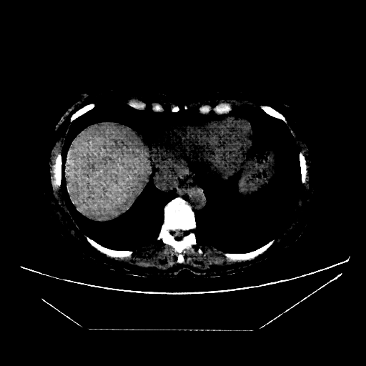 Generated VENOUS CT scan (A→B translation)