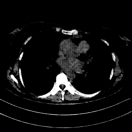Reconstructed NATIVE CT scan (cycle consistency)