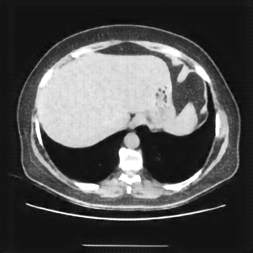 Reconstructed NATIVE CT scan (cycle consistency)