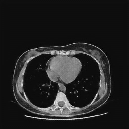 Generated VENOUS CT scan (A→B translation)